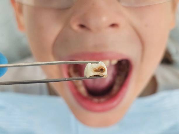 Best Emergency Dental Care for Broken or Chipped Teeth in Airy Heights, WA